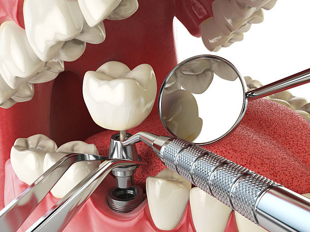 Best Emergency Root Canal Treatment in Shrewsbury, MO